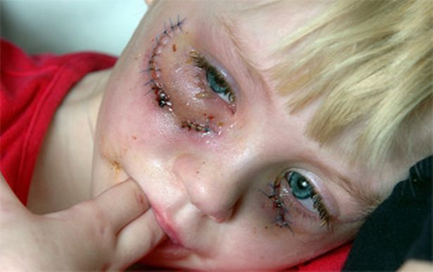 Little girl with scar